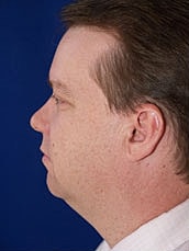 Liposuction Before & After