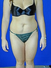 Liposuction Before & After