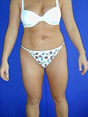 Liposuction Before & After