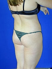 Liposuction Before & After