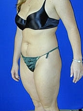 Liposuction Before & After