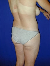 Liposuction Before & After