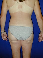 Liposuction Before & After