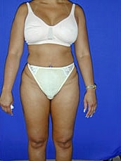 Liposuction Before & After