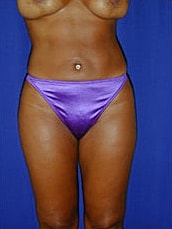 Liposuction Before & After