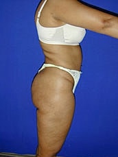 Liposuction Before & After