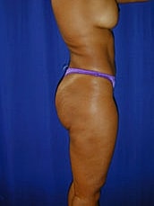 Liposuction Before & After