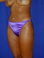 Liposuction Before & After