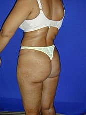 Liposuction Before & After