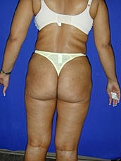 Liposuction Before & After