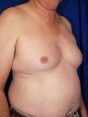 Liposuction Before & After