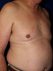Liposuction Before & After