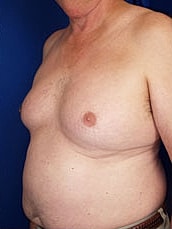 Liposuction Before & After