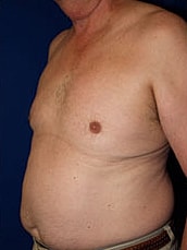 Liposuction Before & After