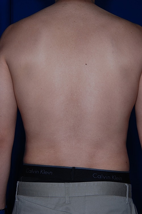Liposuction Before & After
