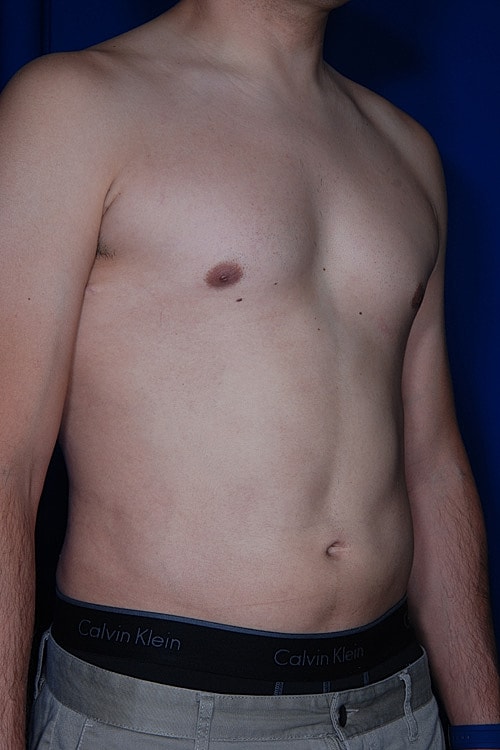 Liposuction Before & After