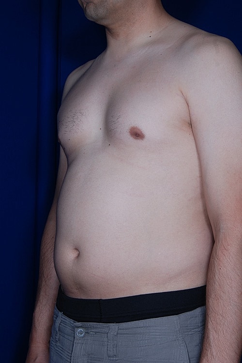 Liposuction Before & After