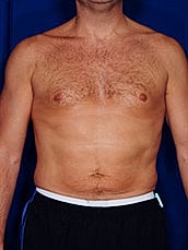 Liposuction Before & After