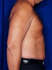 Liposuction Before & After