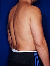 Liposuction Before & After