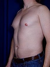 Liposuction Before & After