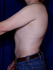 Liposuction Before & After