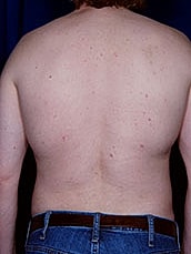 Liposuction Before & After