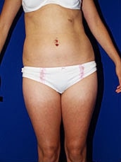 Liposuction Before & After