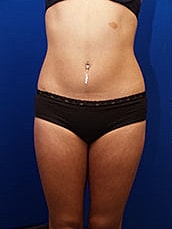 Liposuction Before & After