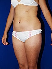 Liposuction Before & After