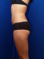 Liposuction Before & After