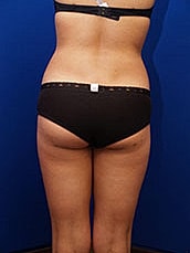 Liposuction Before & After