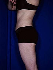 Liposuction Before & After