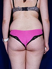 Liposuction Before & After