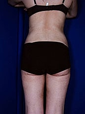 Liposuction Before & After