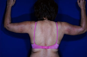 Liposuction Before & After