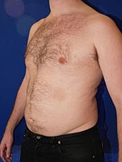 Liposuction Before & After