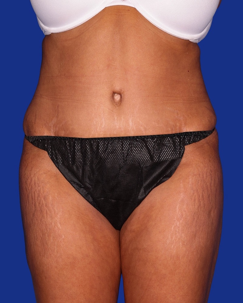 Liposuction Before & After