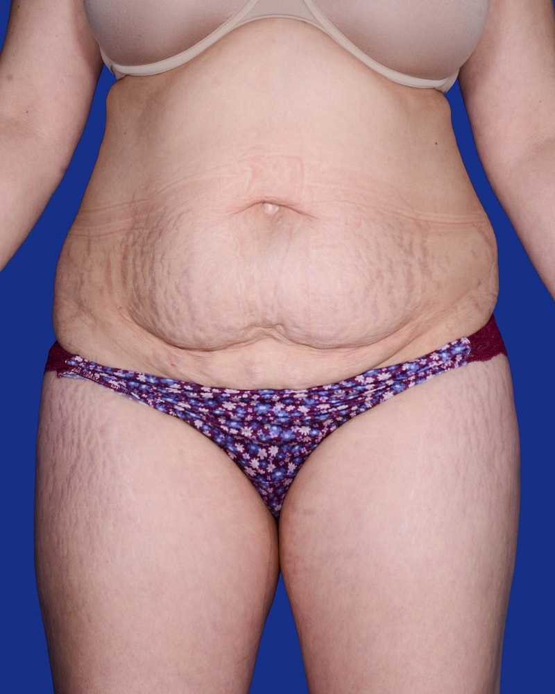 Liposuction Before & After