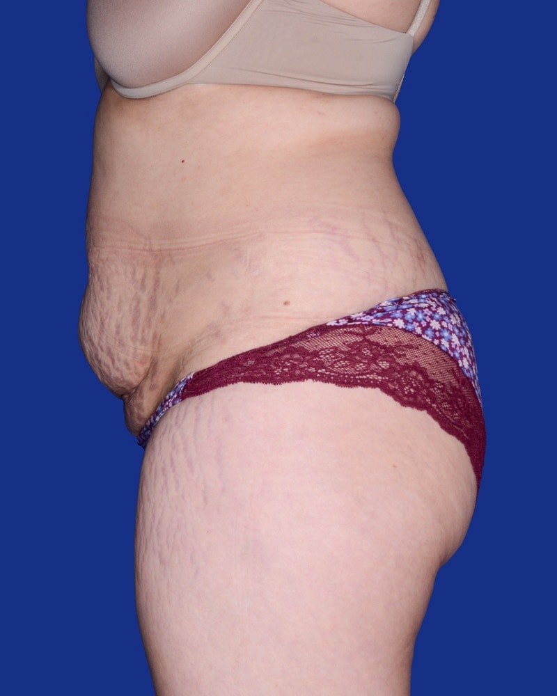 Liposuction Before & After