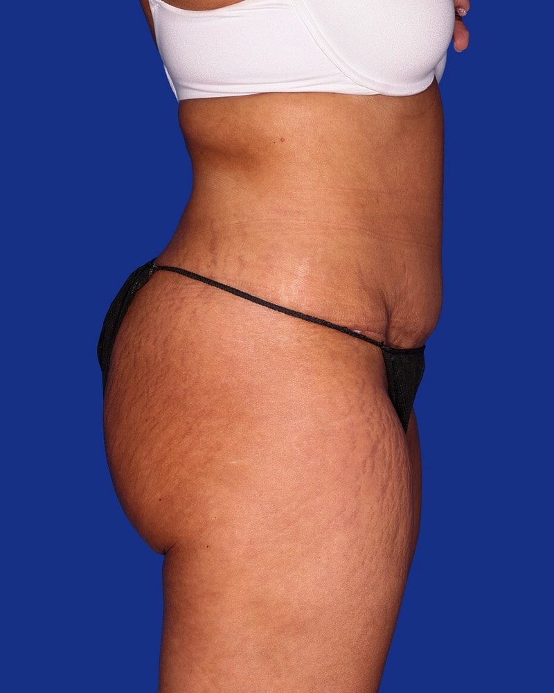 Liposuction Before & After
