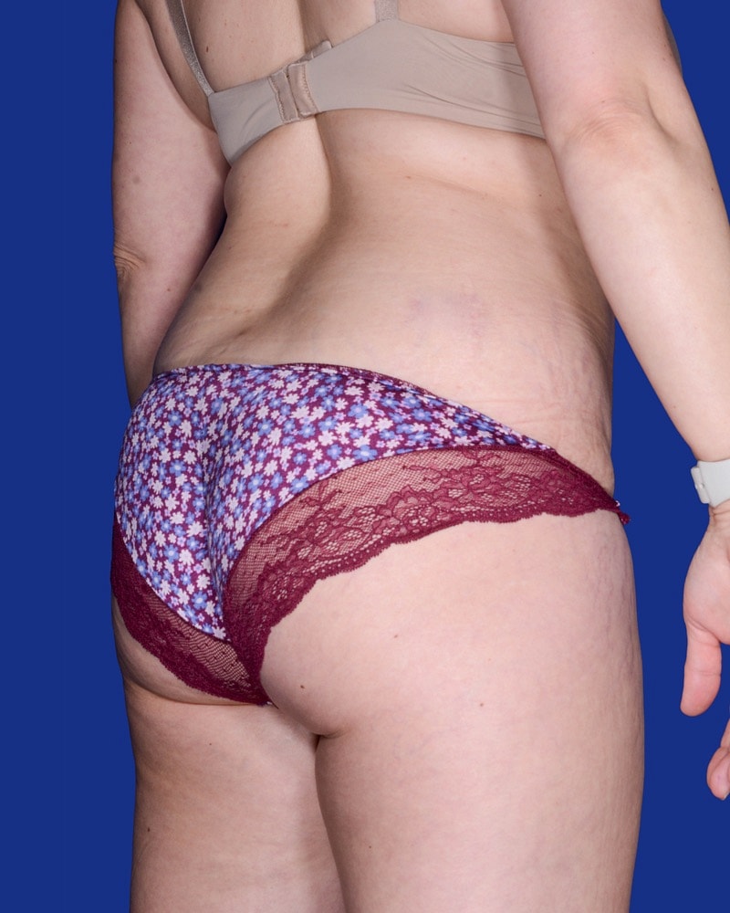 Liposuction Before & After