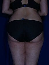 Liposuction Before & After