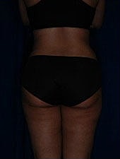 Liposuction Before & After