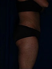 Liposuction Before & After