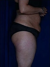 Liposuction Before & After