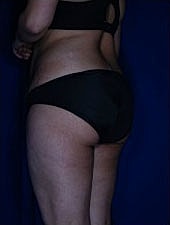 Liposuction Before & After