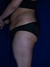 Liposuction Before & After