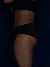 Liposuction Before & After