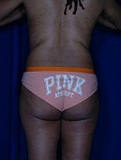 Liposuction Before & After